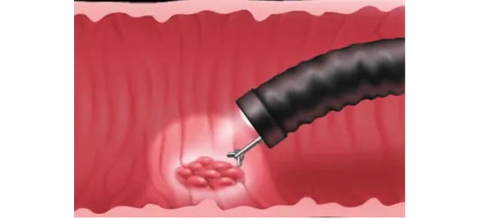 Endoscopia Gastrointestinal Leon Gto