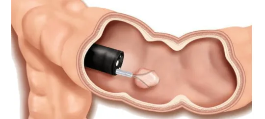 Endoscopia Gastrointestinal Leon Gto