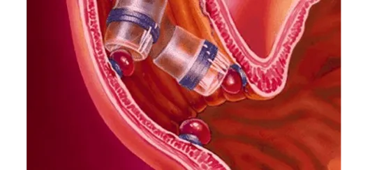 Endoscopia Gastrointestinal Leon Gto